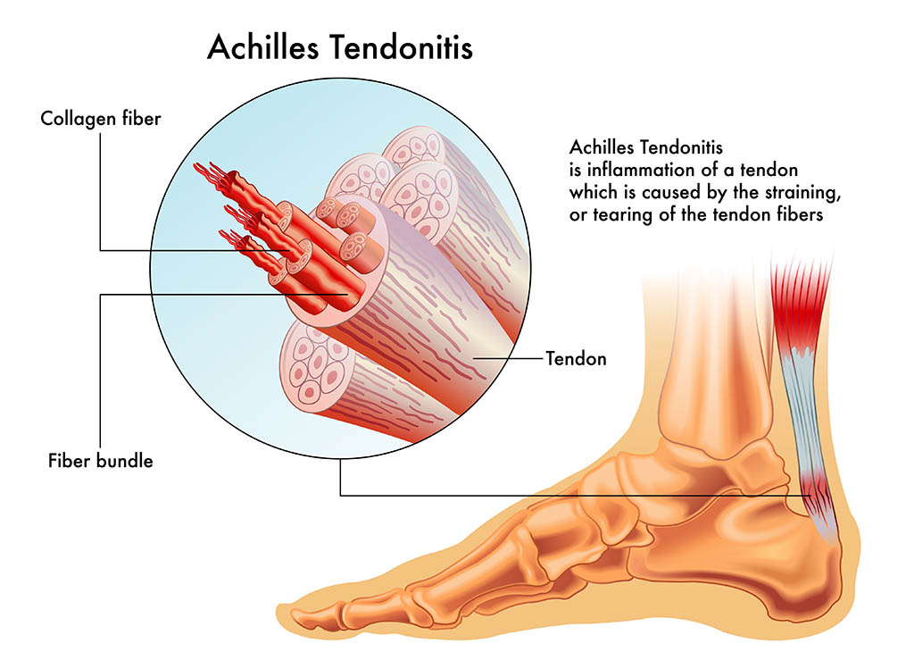 Achilles Tendonitis graphic, common foot problems