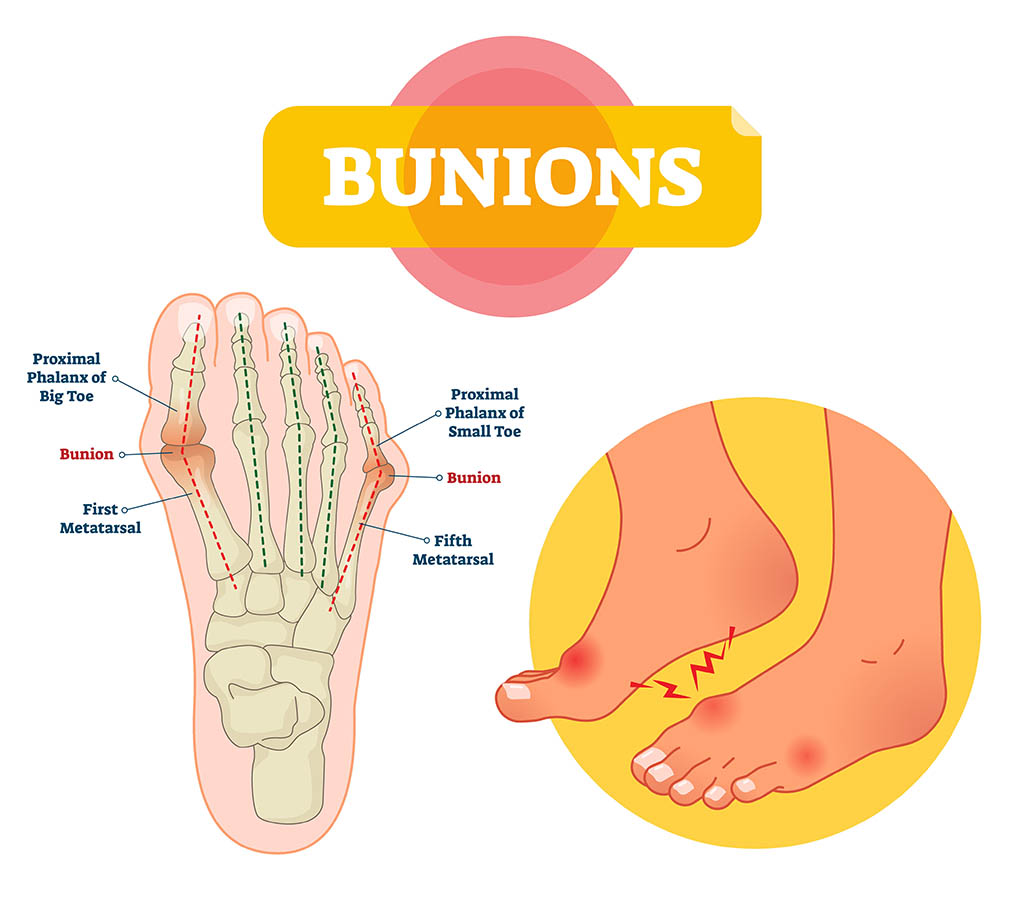 bunions common foot problems, Bunions vector illustration. Labeled feet bone disorder explanation scheme. Painful toe joint condition. Orthopedics inflammation problem with deformity. Medical barefoot xray infographic diagram.