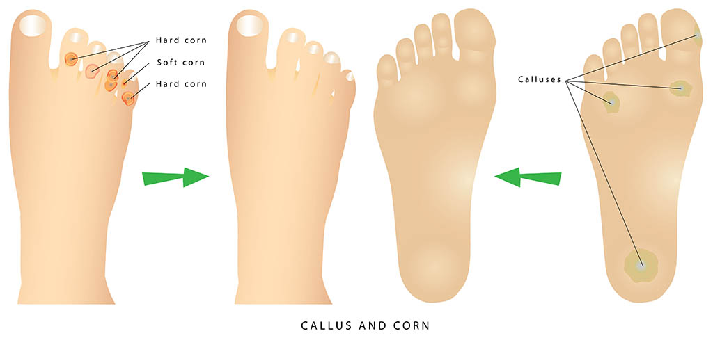 foot corns, calluses graphic, common foot problems, feet illustration, dead hard skin