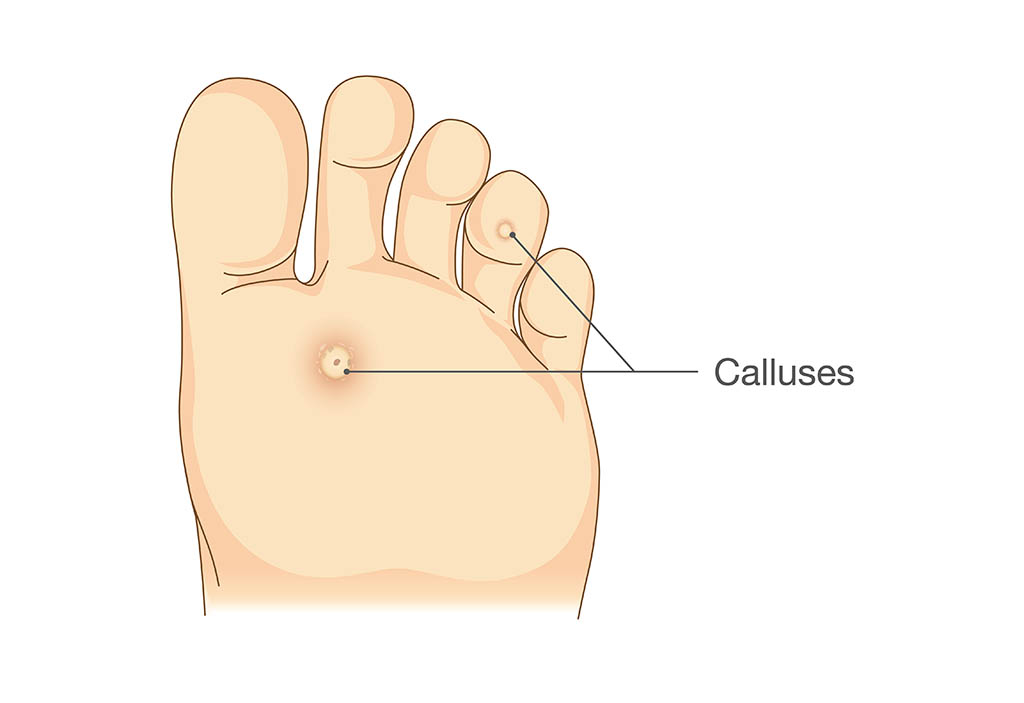 calluses graphic, common foot problems, feet illustration, dead hard skin