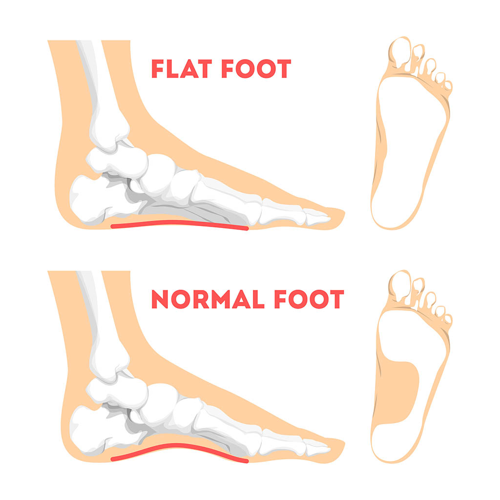 common foot problems, Human foot pathology infographic. Flat foot anatomy. Deformed and healthy footprint. Illness therapy. Isolated vector illustration in cartoon style