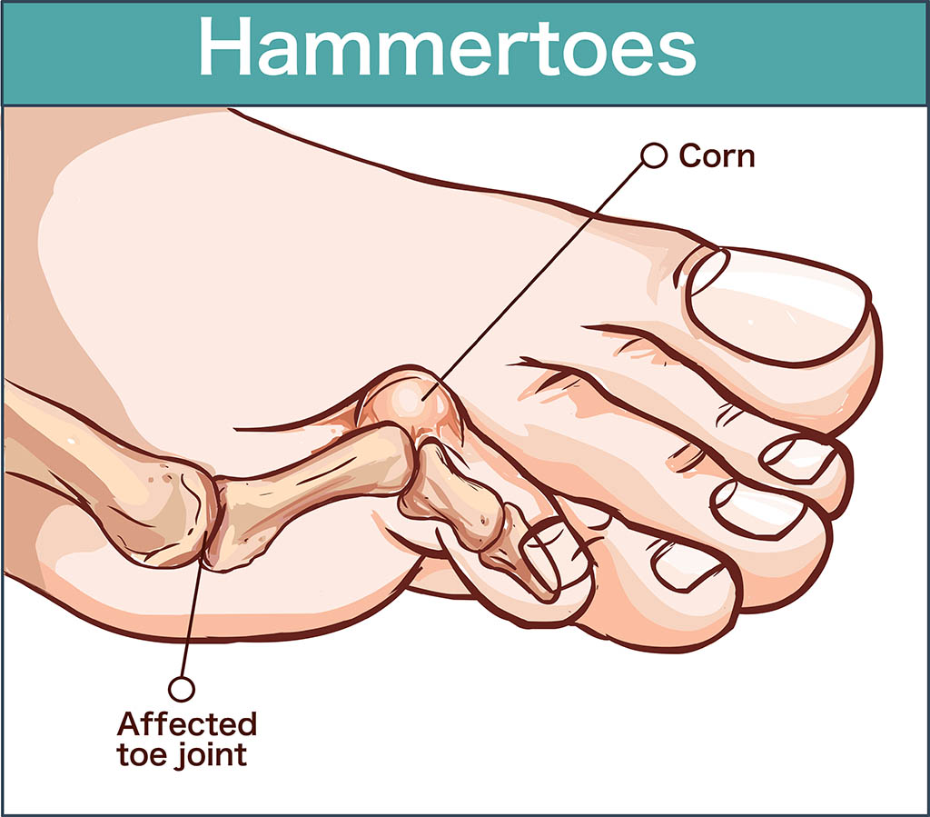 common foot problems, vector illustration of a hammertoes .