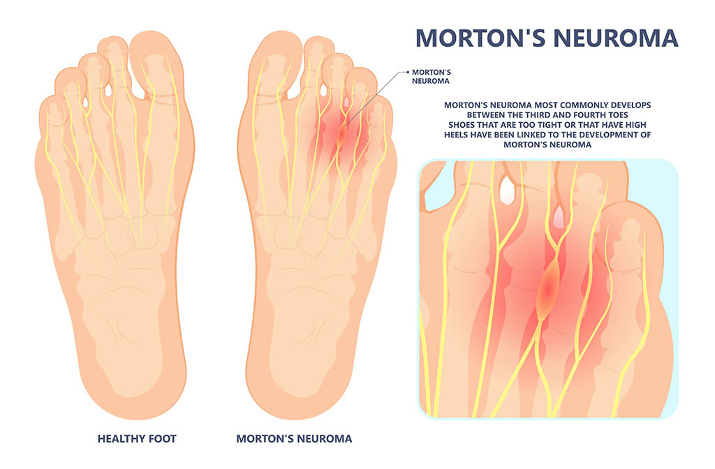 mortons neuroma graphic, common foot problems