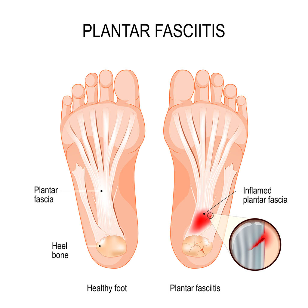 common foot problems, Plantar fasciitis. disorder of the connective tissue which supports the arch of the foot. vector diagram for medical, educational and scientific use