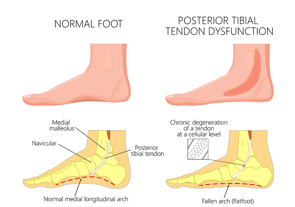 Posterior Tidal Tendonitis graphic illustration, common foot problems